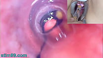 Mature Woman Peehole Endoscope Camera in Bladde... Konulu Porno